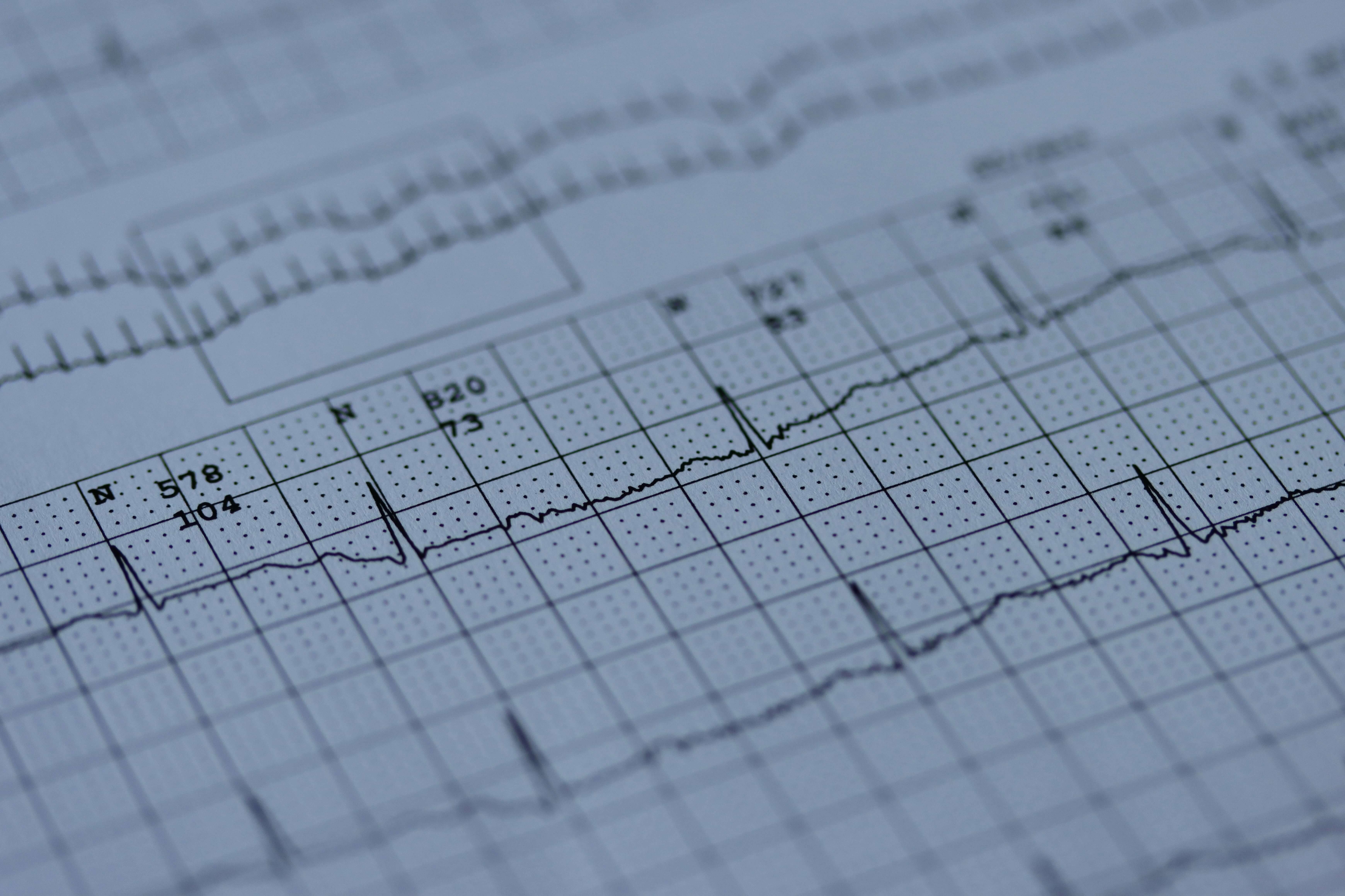 EKG-tolkning